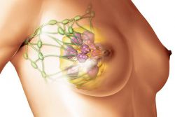 fibrózní prsní mastopatie