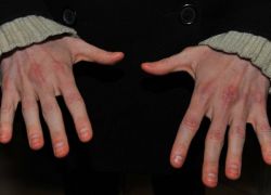 učinke krčevih prstov