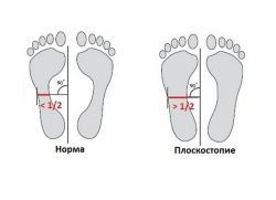 vrste ploskih stopal pri otrocih