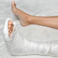 leczenie złamania kości śródstopia stopy