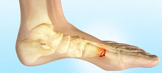 Simptomi i liječenje artroze zglobova stopala - Artroza 