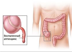 gangrenózní apendicitida s peritonitidou