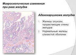 Adenokarcinom želodca