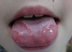 łuszczycowe zapalenie języka