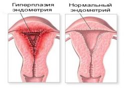glandulární xytóza léčba hyperplázie endometria