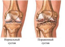 Gonartrozu zglobova koljena 2 stupnja