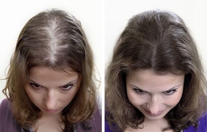 presaditev las pri ženskah