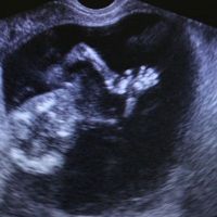 Ali je škodljivo narediti ultrazvok za nosečnice?