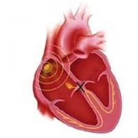 симптоми на сърдечния блок