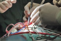 myxoma srdeční chirurgie