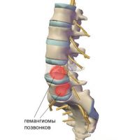 симптоми на гръбначния хемангиом