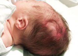 hematom na hlavu dítěte