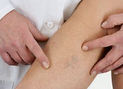 Zdravljenje hematoma na nogi po modrici