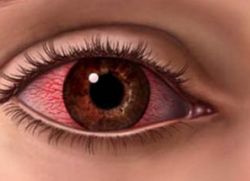 silny krwotok w oku