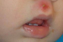 herpes virus pri zdravljenju otrok