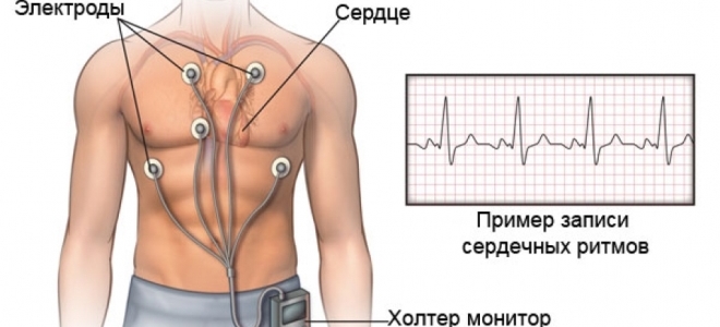 Holter nadzorni sistem