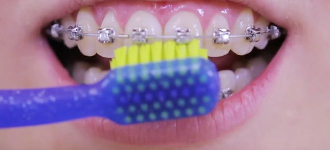 Как чистить зубы с брекетами зубной щеткой третий