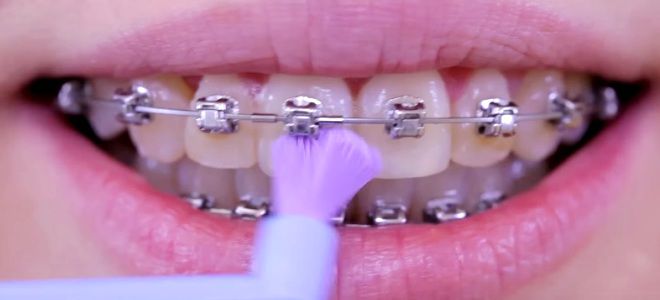 Как чистить зубы с брекетами зубной щеткой шестой