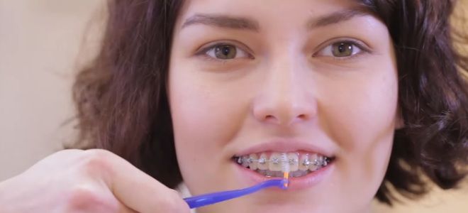 Как чистить зубы ершиком для брекетов первый