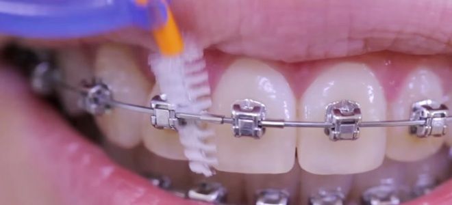 Как чистить зубы ершиком для брекетов второй