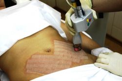 kako ukloniti strijama na abdomenu nakon porođaja