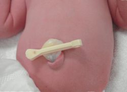 Как да се справим с пъпа на новородено с кърпа