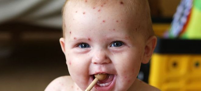 Как да се лекува варицела при деца