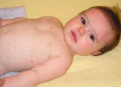 Как да лекувате варицела при деца под една година
