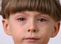 Virusni konjunktivitis kod djece