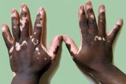 léky na vitiligo
