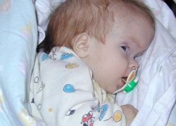 simptomi hidrocefalusa pri dojenčkih