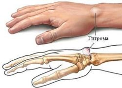 roko hygroma