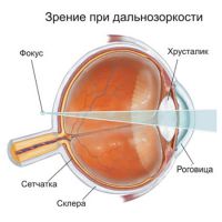 хиперметропија ока