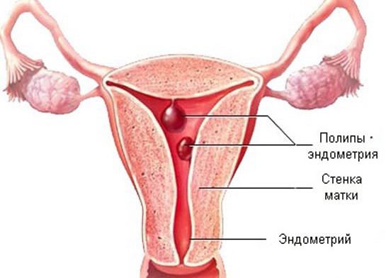 Przerost endometrium