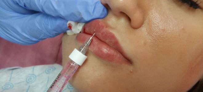 процедура увеличения губ гиалуроновой кислотой