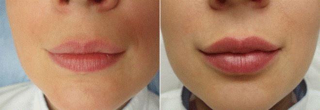 увеличение губ гиалуроновой кислотой до и после