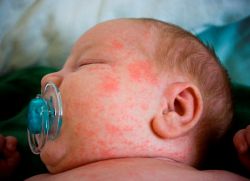 Инфузија новорођенчета на лице