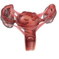 wewnętrzna endometrioza macicy
