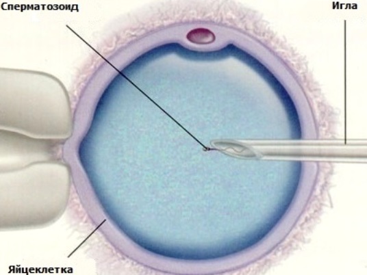 intracytoplazmatická injekce spermií