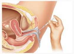 intrateuter insemination catheter