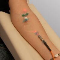VLOK intravenózní laserové ozařování krve