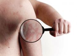 je kožna psoriaza nalezljiva?