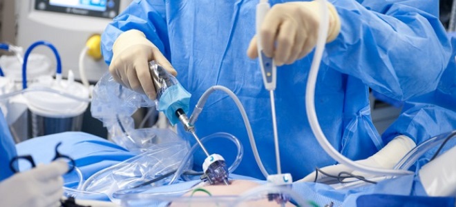 laparoskopie ovariálních cyst
