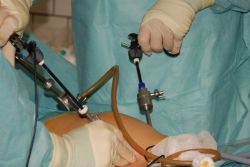 uklanjanje laparoskopije jajnika