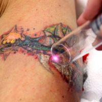 премахване на лазерна татуировка