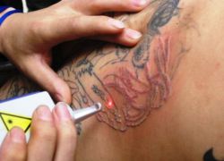 odstranění neodymového laserového tetování