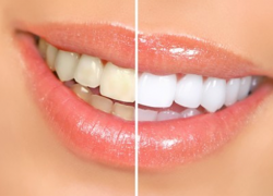 efektivní bělení zubů