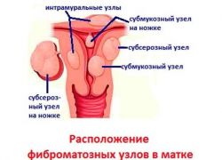 maternični vozli