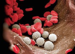 Příčiny leukocytózy v krvi