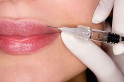 korekcija ustnic s hialuronsko kislino